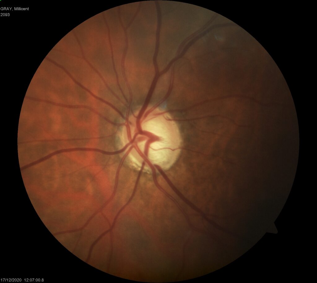 glaucoma3