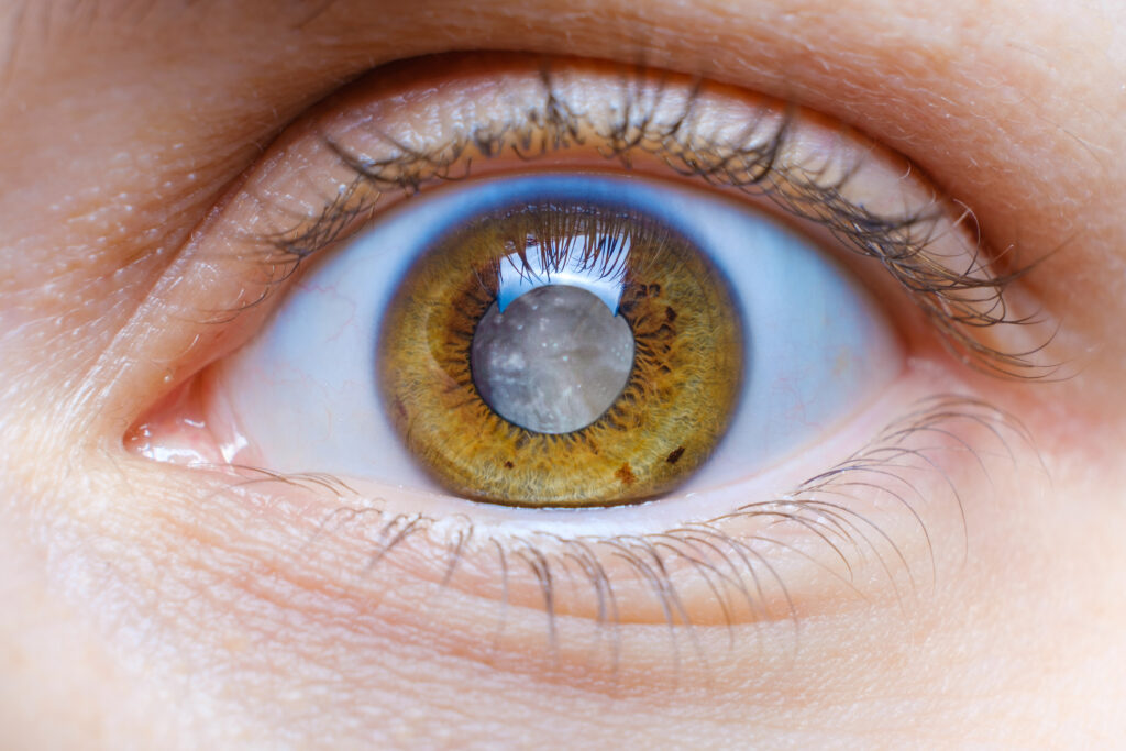 human eye with clouded lens, white pupil, cataract macro