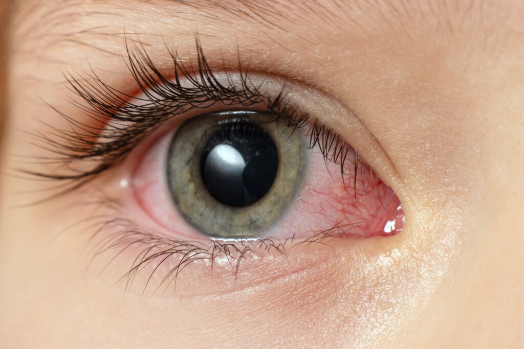 closeup irritated infected red bloodshot eyes, conjunctivitis